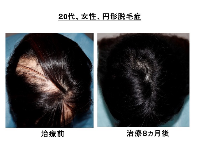 円形脱毛症　病院